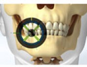 Advanced Technology Makes Dental Implants Safer Than Ever