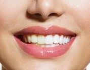 Dental Implants: Do They Discolor Over Time?