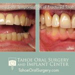 TahoeOralSurgery-BeforeAfter-1603-1