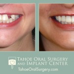 TahoeOralSurgery-BeforeAfter-1603-2