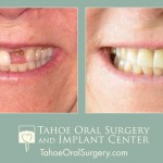 TahoeOralSurgery-BeforeAfter-1603-3