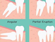 What is an impacted tooth and how is it treated?