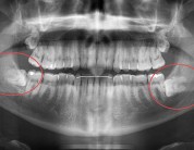 Do I really need to have my wisdom teeth removed?
