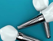Eight Things to Know Before Getting Dental Implants – Dental Implant FAQs
