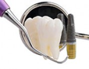 Top 10 reasons to get dental implants versus other treatment options