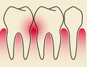 Gum Disease and its effect on you